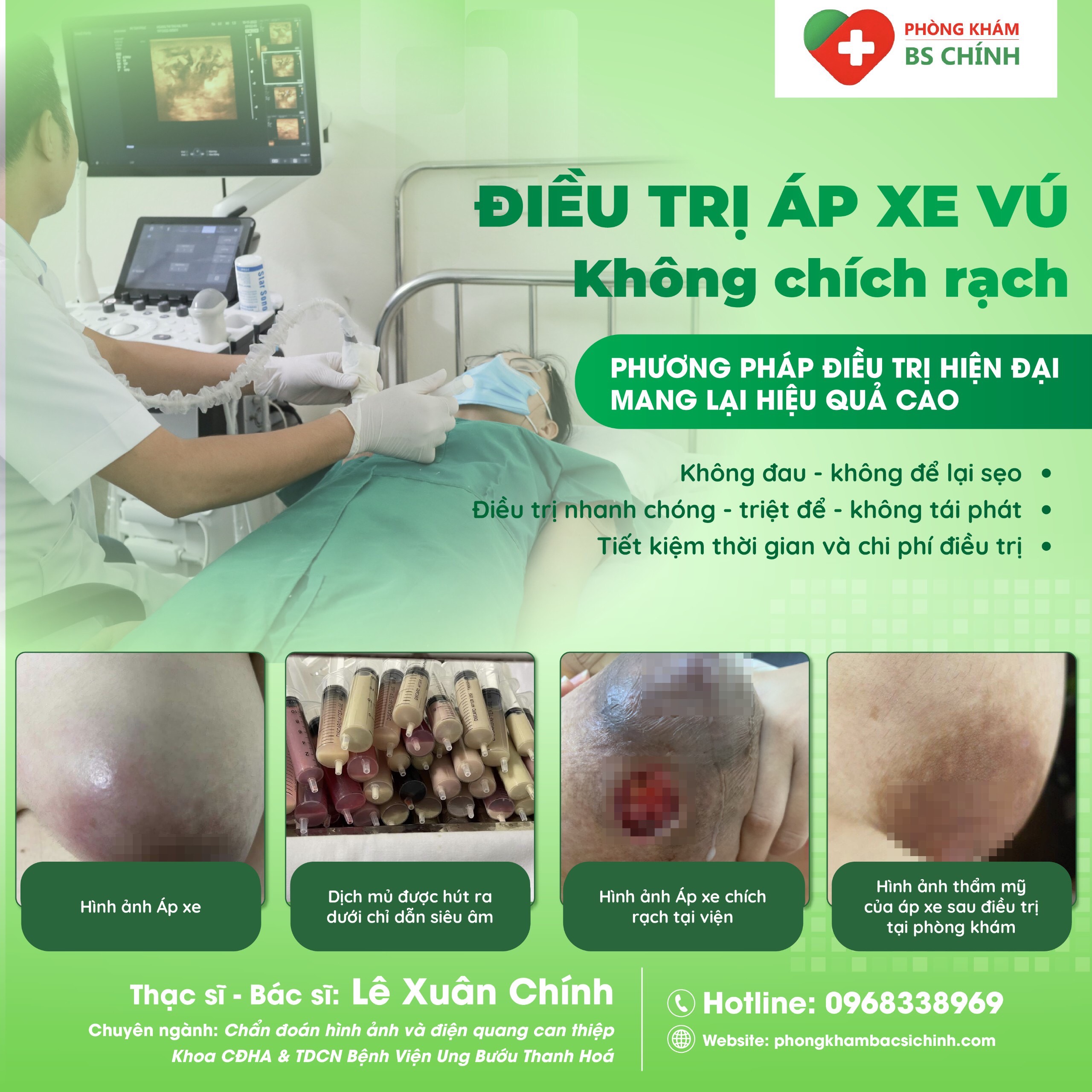 Áp xe vú không chích rạch là phương pháp điều trị vô cùng an toàn và hiệu quả, giúp giảm đau và khắc phục tình trạng viêm nhiễm của vùng ngực. Nếu bạn đang có những vấn đề về vú, hãy xem hình ảnh liên quan để tìm hiểu thêm về phương pháp trị liệu này.